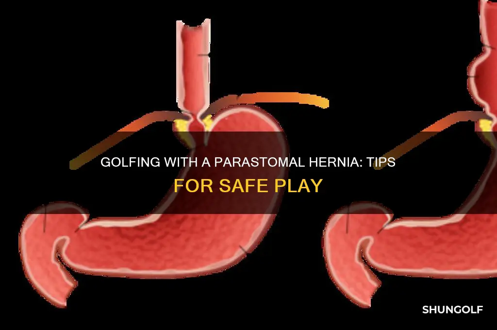 can i play golf with a parastomal hernia