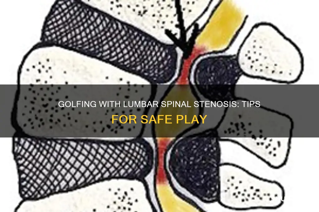 can i play golf with lumbar spinal stenosis