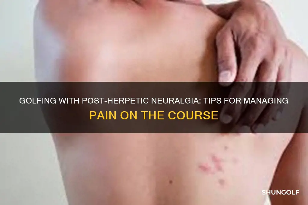 can i play golf with post-herpetic neuralgia