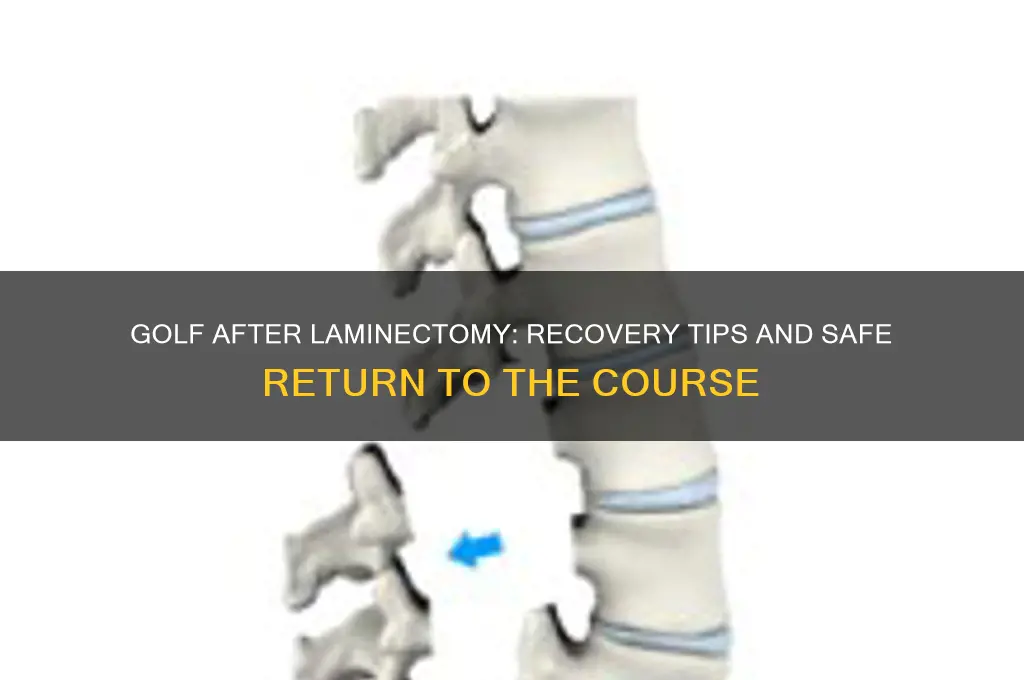 can you play golf after a laminectomy