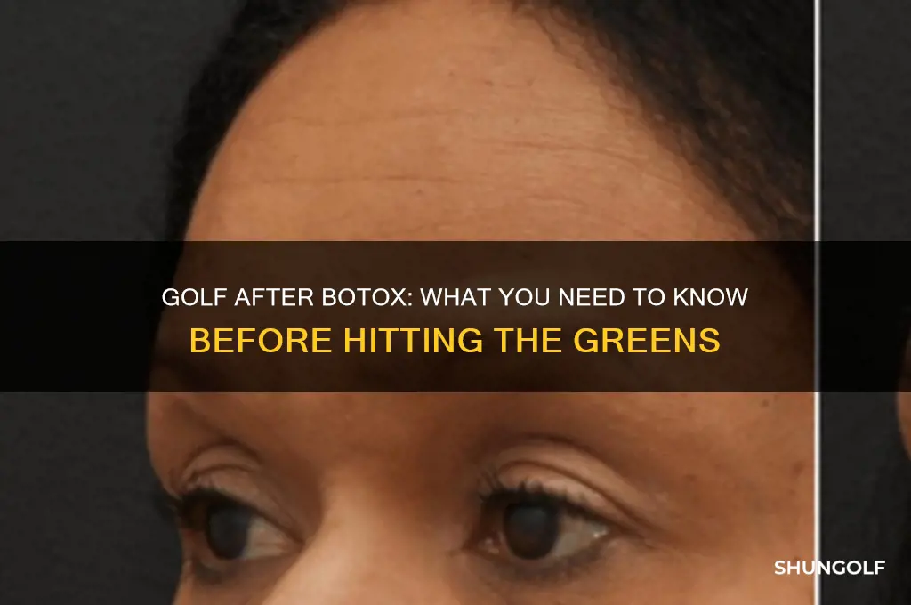 can you play golf after botox