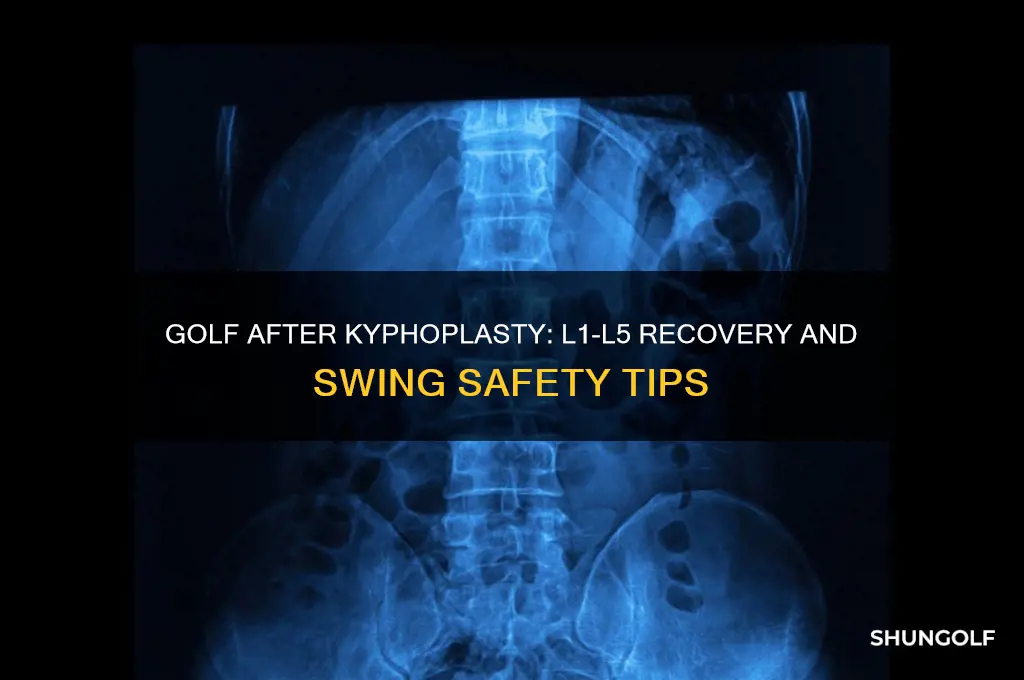 can you play golf after kyphoplasty of l1 through l5