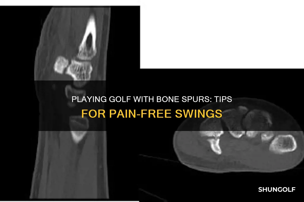 can you play golf with bone spurs