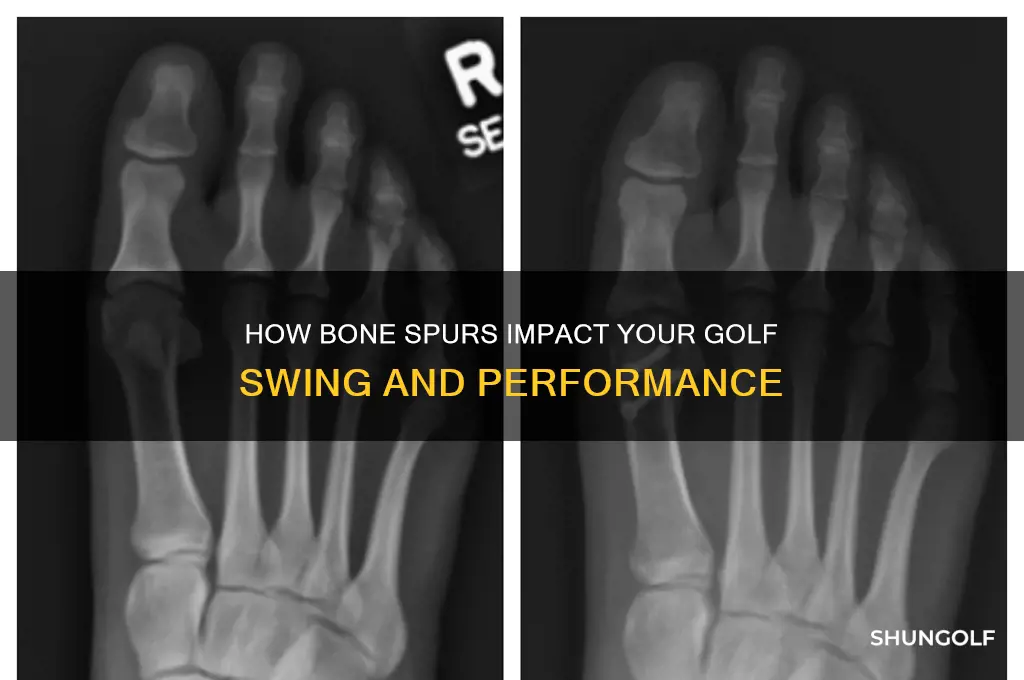 do bone spurs affect golf game