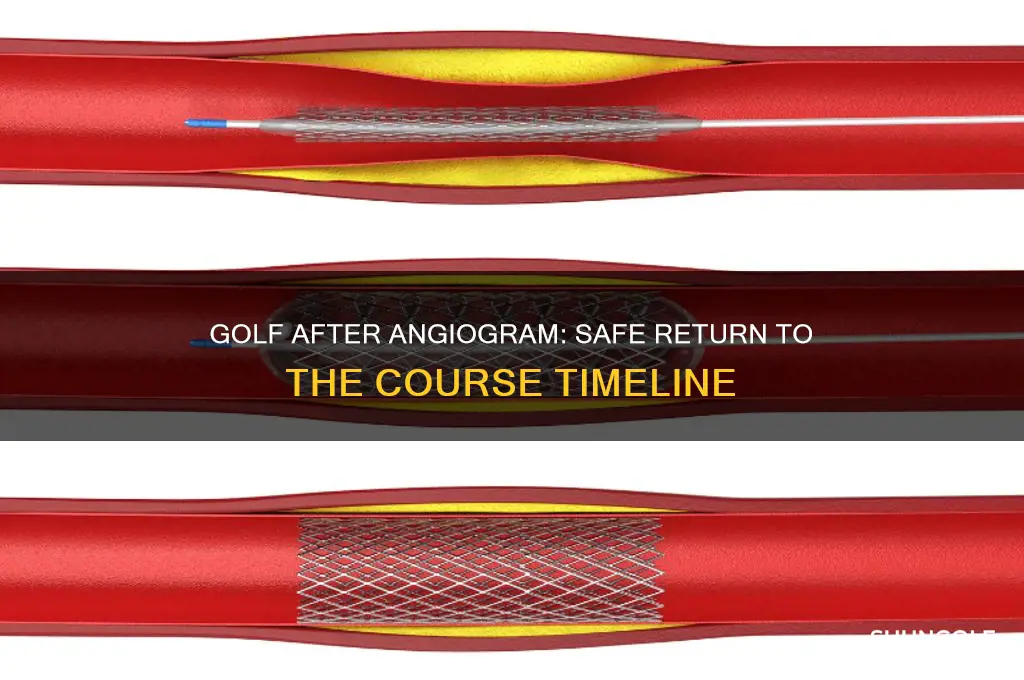 how long after angiogram can i play golf
