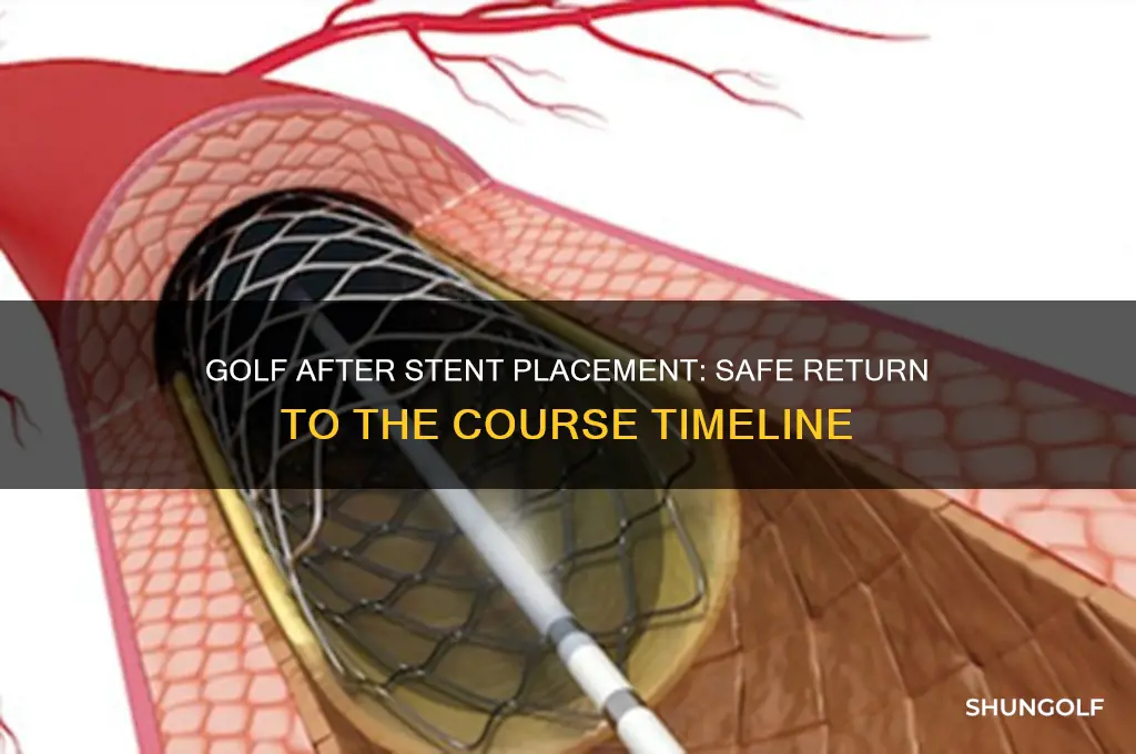 how long after getting stent before i can play golf