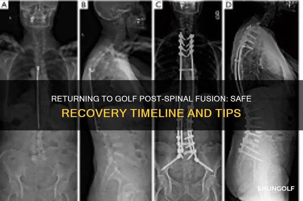 how long to resume golf after spinal fusion