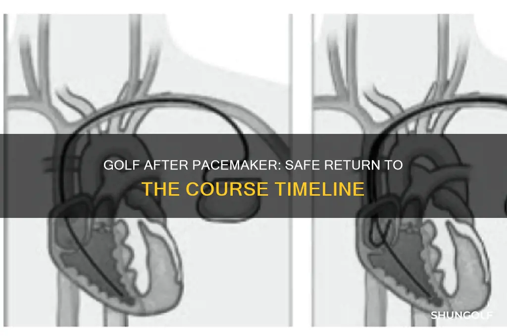 how soon can i play golf after getting a pacemaker
