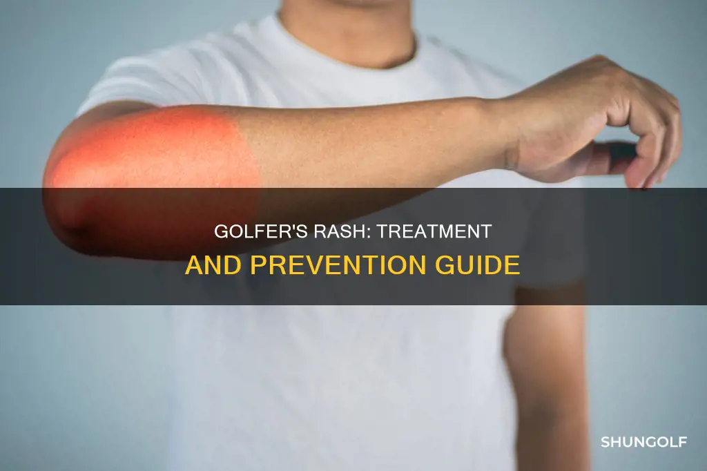 how to treat golfer