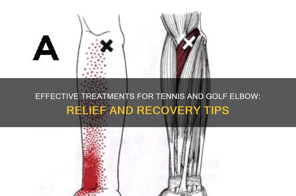 how to treat tennis and golf elbow