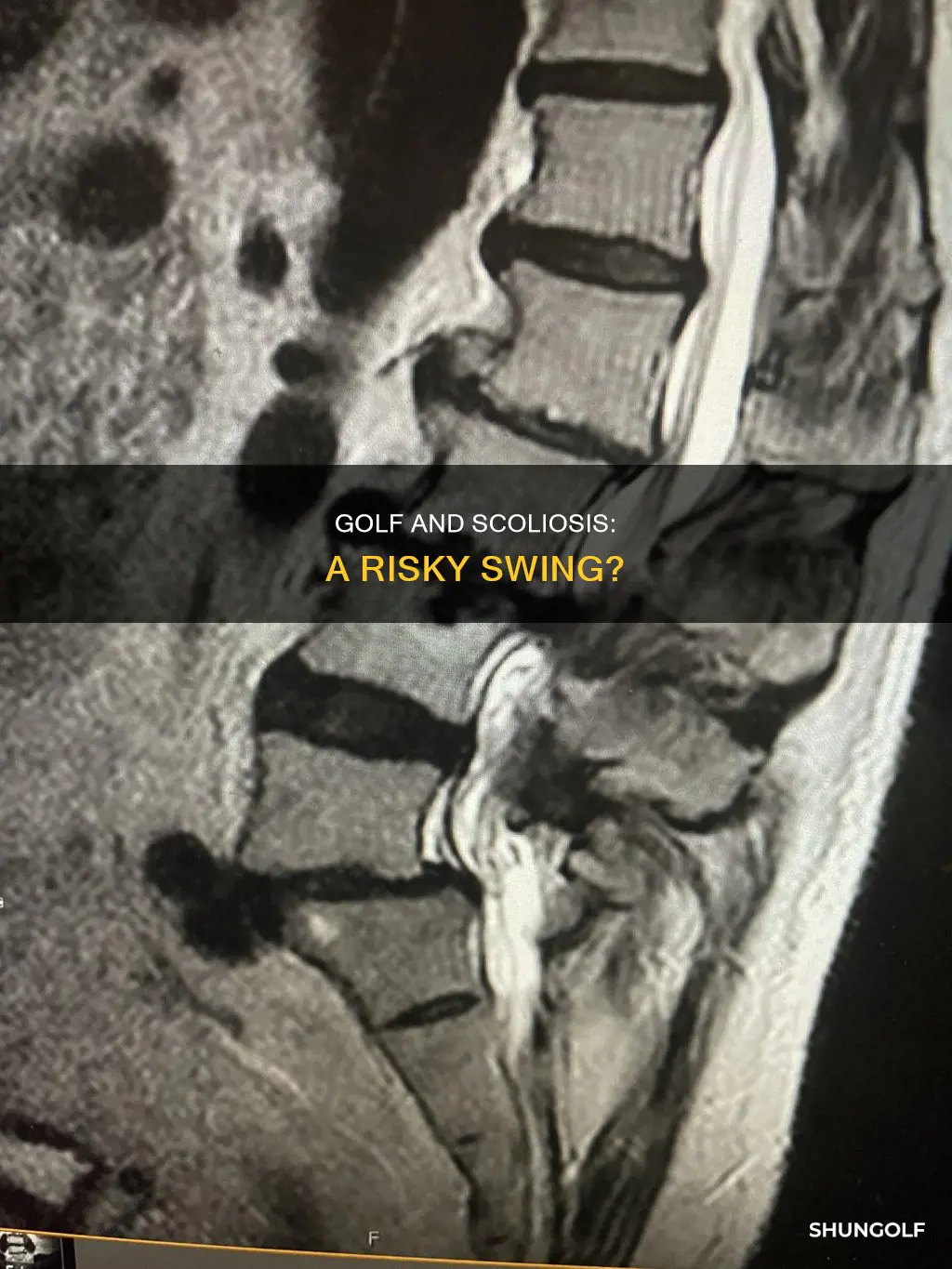 is golf bad for scoliosis