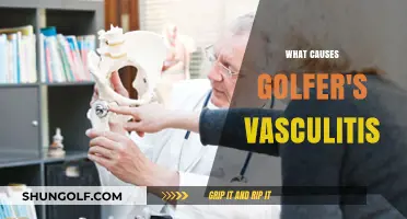 Golfer's Vasculitis: What's the Underlying Cause?