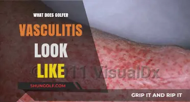 Golfer's Vasculitis: Symptoms, Appearance, and What to Look For