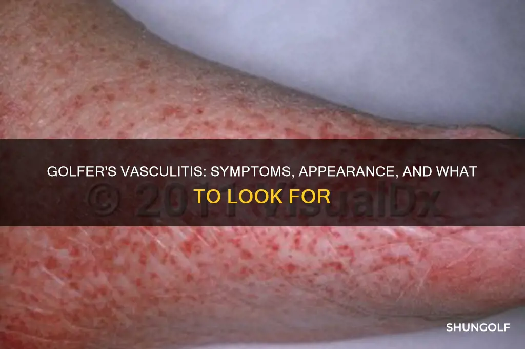 what does golfer vasculitis look like