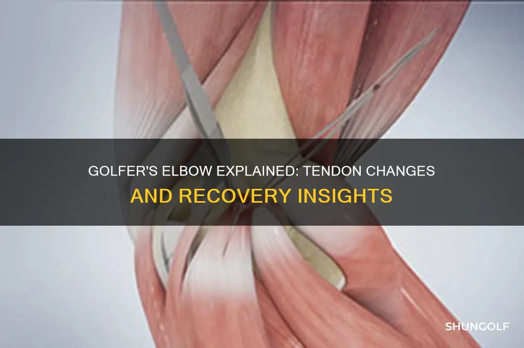 what happens to the tendon in golfer