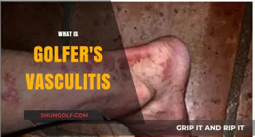 Golfer's Vasculitis: Understanding the Pain and Discomfort