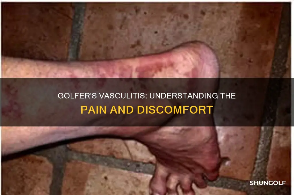 what is golfer