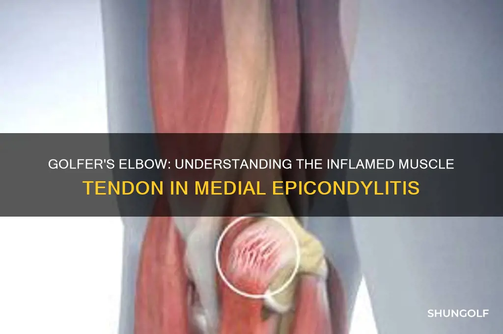 what muscle tendon is inflamed in golfer elbow