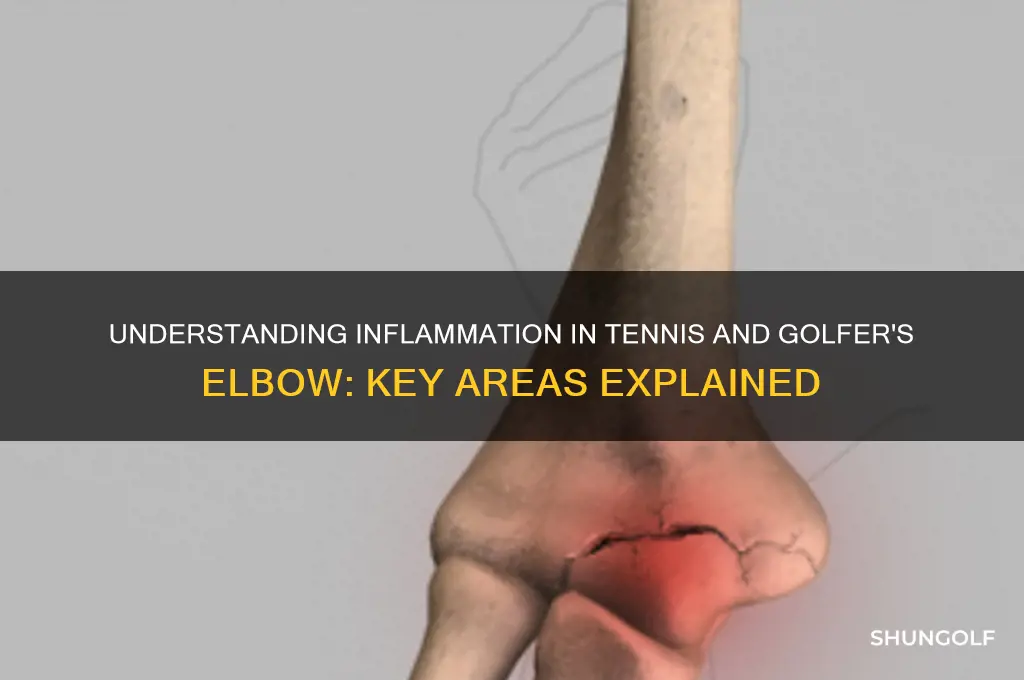 where does inflammation occur in tennis and golfer