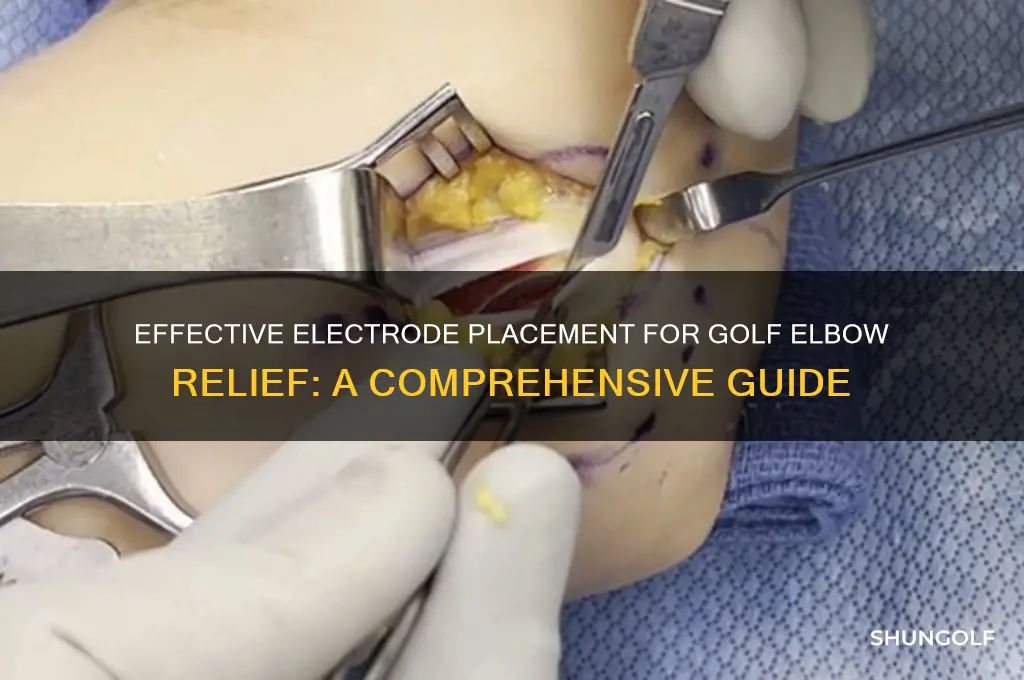 where to place electrodes for golf elbow